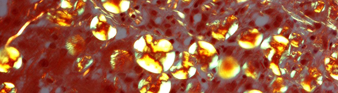 Globules showing an apple green birefringence