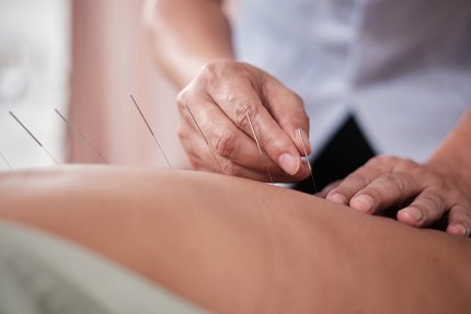 A medical professional places acupuncture needles on a patient's back.