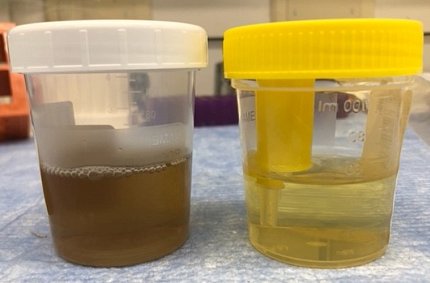 Two urine samples in cups, one light yellow, one dark brown