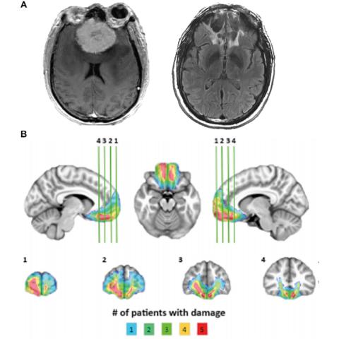 MRI image of a human brain with a tumor (left) and the same brain after the tumor was removed (right). Below, diagrams showing different views of a human brain with lines numbered one through four running through the brain to show the extent of each patients' tumor.